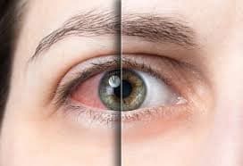 Cornea Services & Dry Eye Treatment